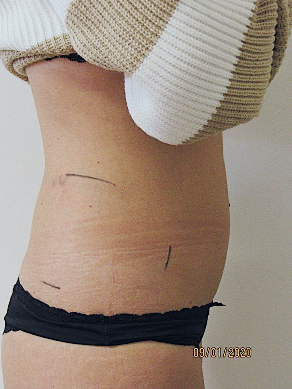 Kryolipolyse Was du zum Thema wissen